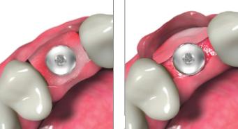 Peiner Zahnarztpraxis Pfeiffer + Platen: „Implantate schenken Lebensqualität“-2