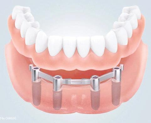 Besserer Halt bei zahnlosem Ober- und Unterkiefer: Das All-On-4-Konzept®-2
