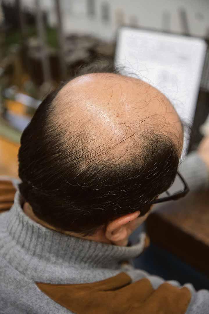 Wenn die Haare ausfallen: Was Männern hilft-2