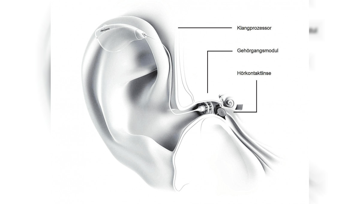 Hörverlust: etwa jeder zehnte ist betroffen