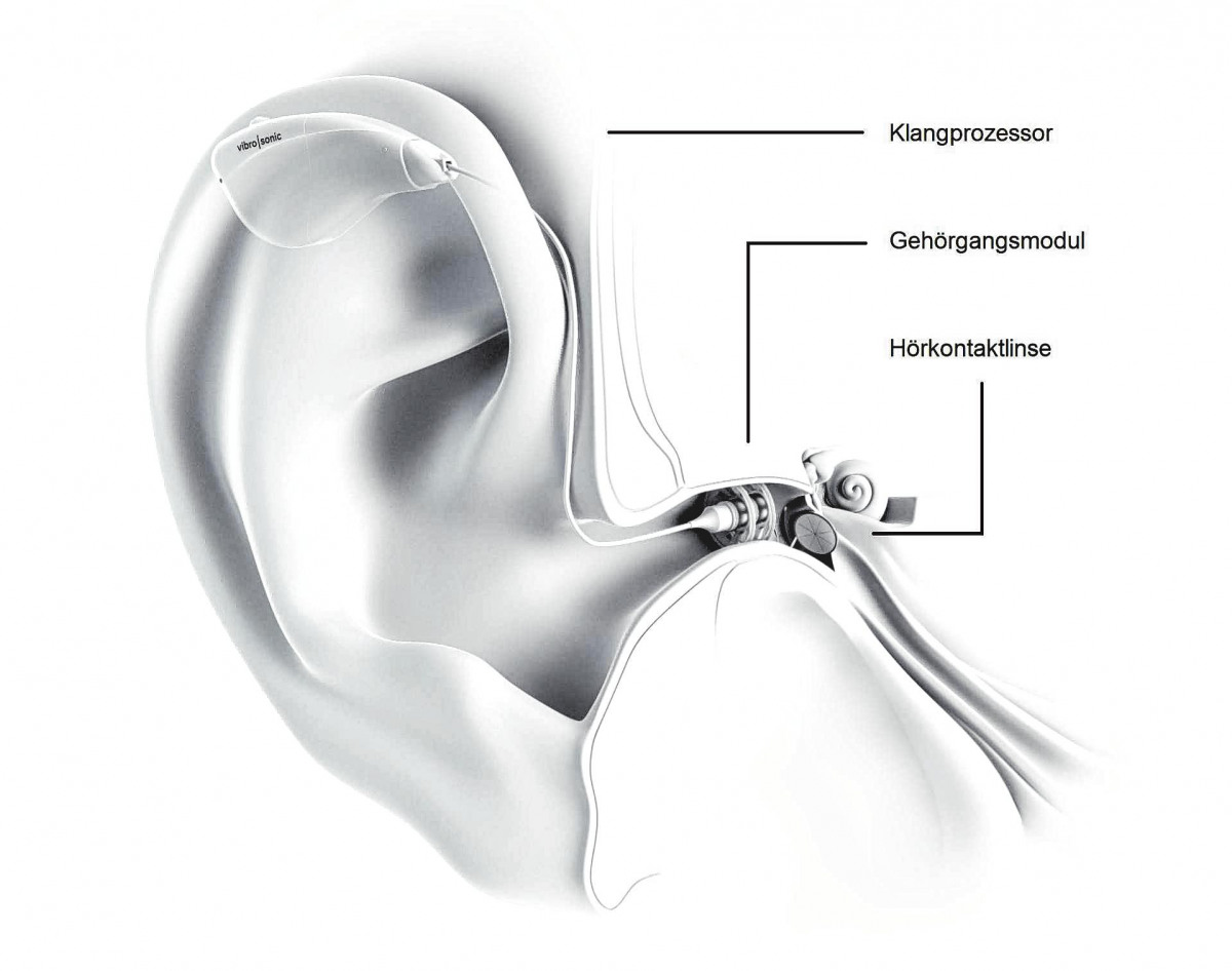 Hörverlust: etwa jeder zehnte ist betroffen