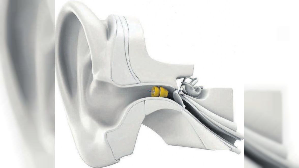 Im-Ohr-Hörgeräte: Viel zu hören, nichts zu sehen