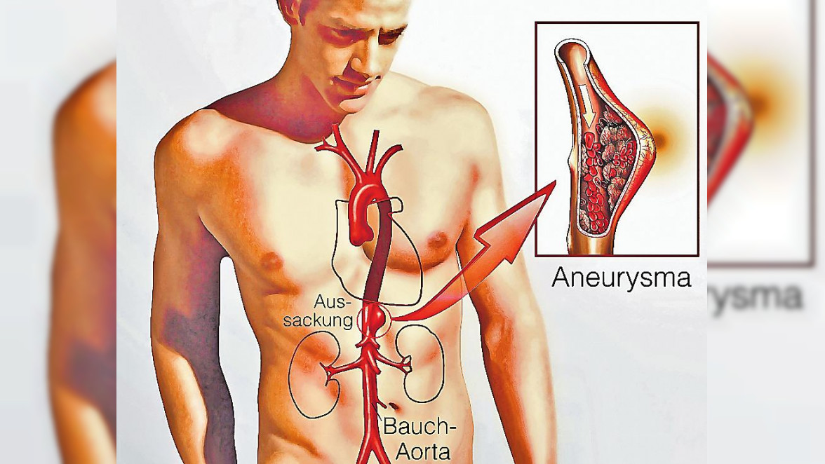 Das Aortenaneurysma – Die unsichtbare Gefahr
