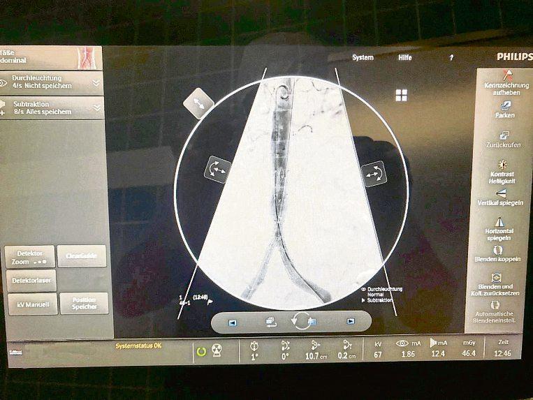 Bauchaortenaneurysma – die tickende Zeitbombe-2