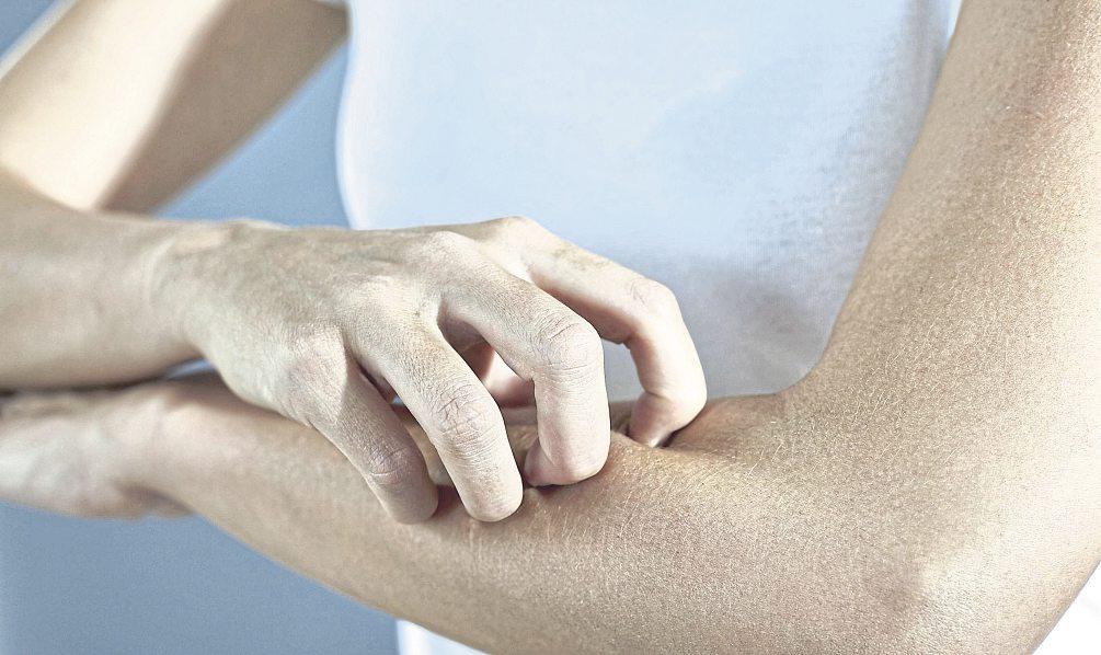 Neurodermitis – neue Therapieansätze lassen hoffen
