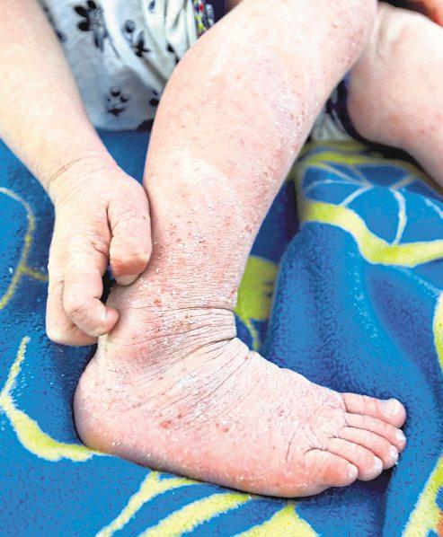 Neurodermitis – neue Therapieansätze lassen hoffen-2